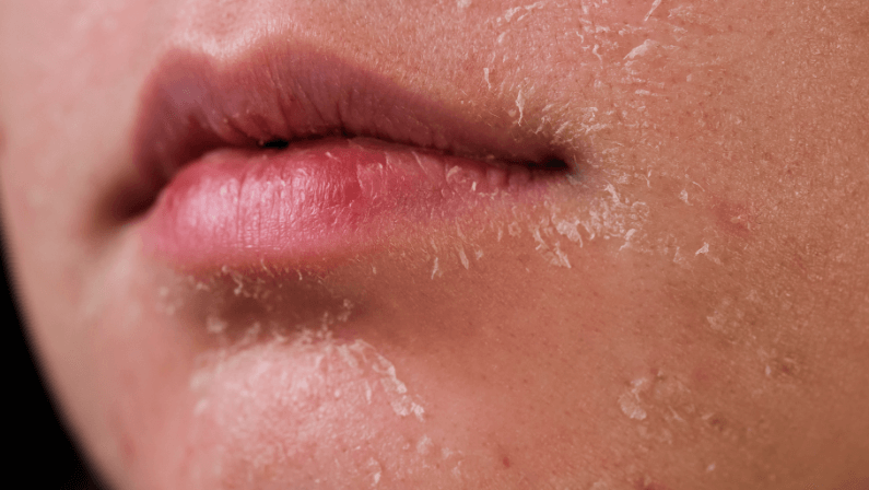 dry flaky skin of a girl due to dehydration