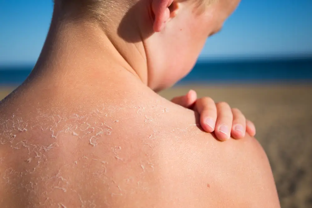 Sunburn on the back of a young boy