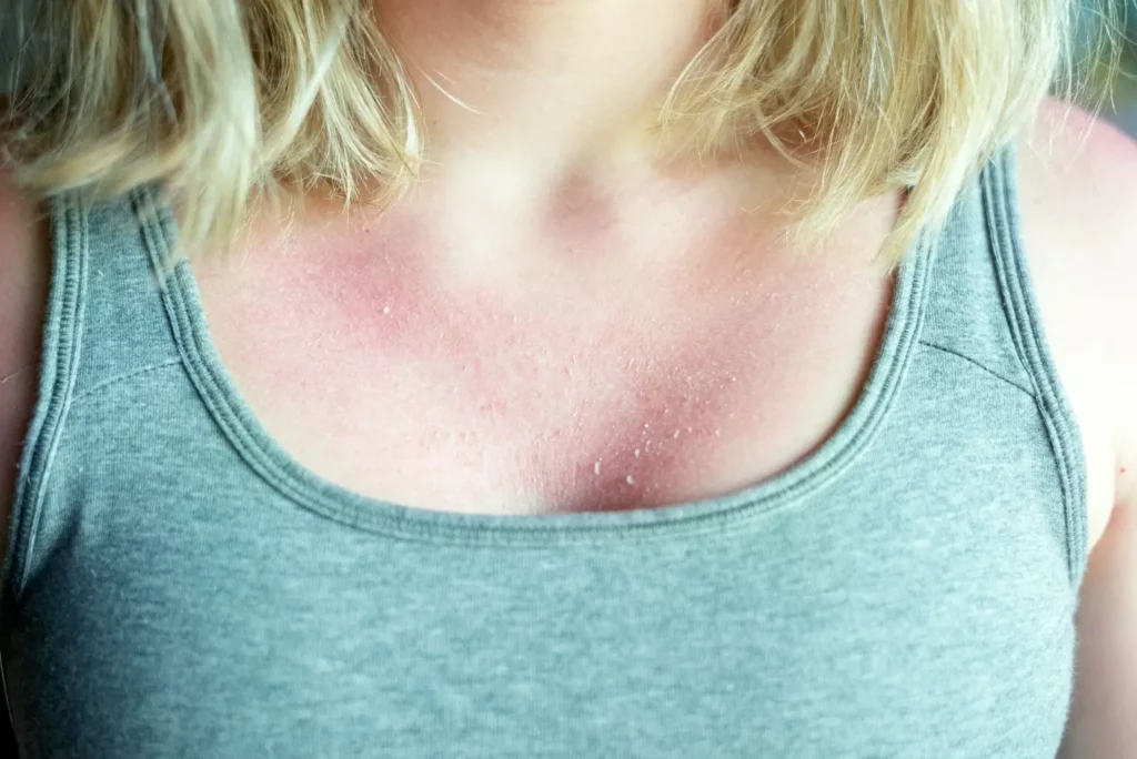 How to Stop Sunburn Itching
