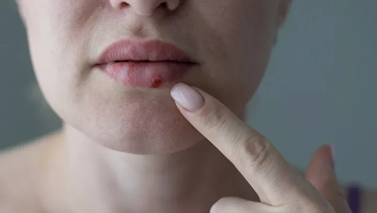 The woman with a virus herpes on lips