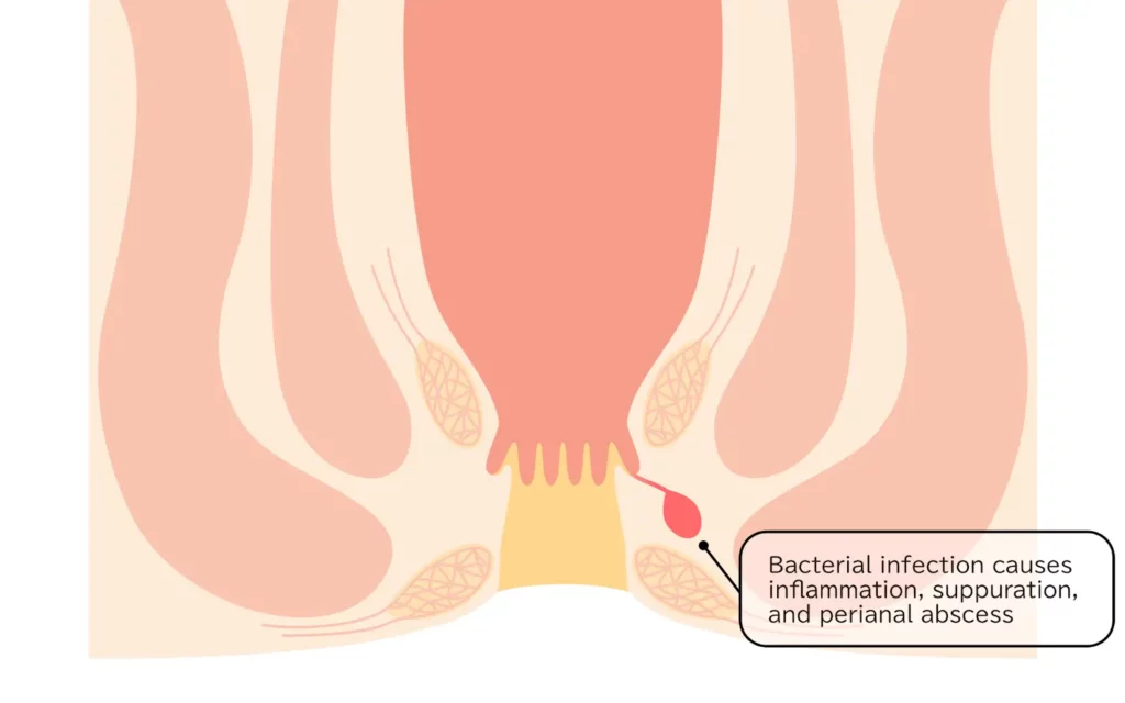 perianal abscess