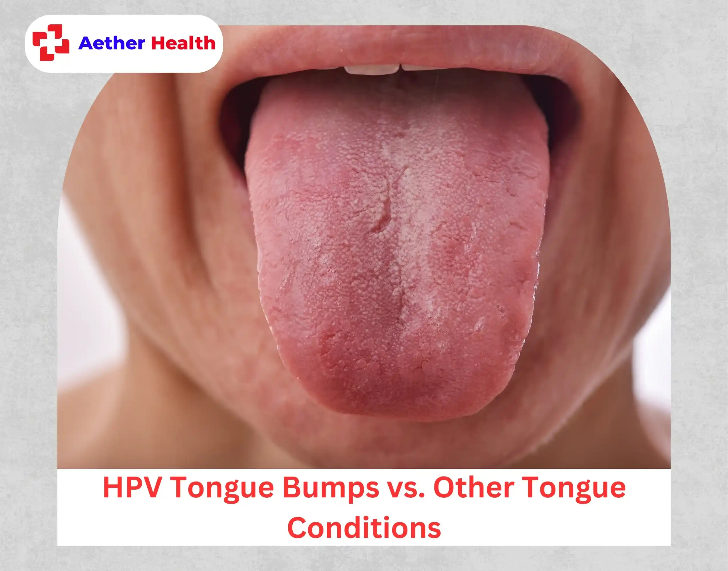 HPV Tongue Bumps vs. Other Tongue Conditions