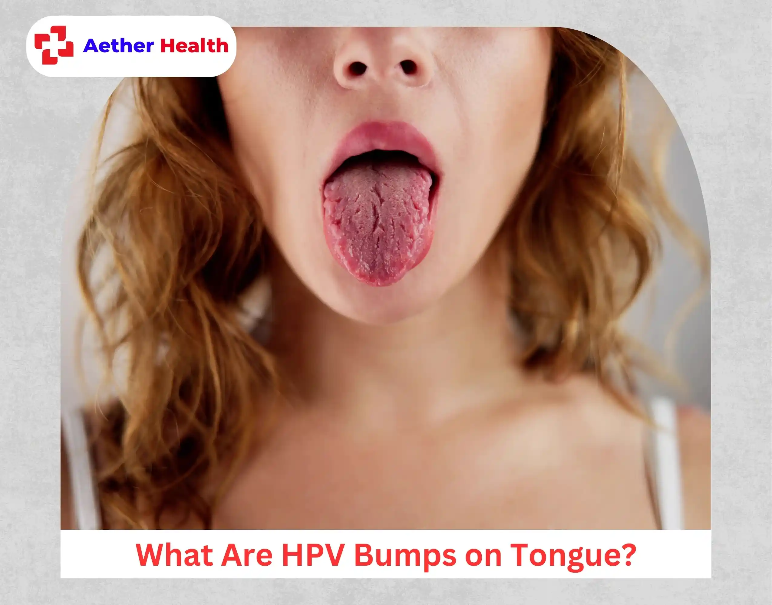 What Are HPV Bumps on Tongue