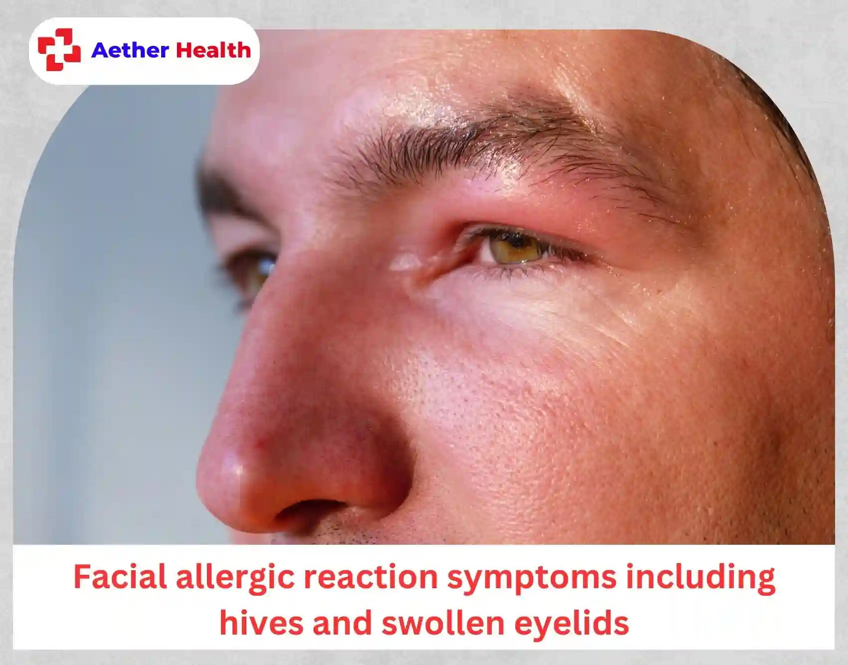 Facial allergic reaction symptoms including hives and swollen eyelids