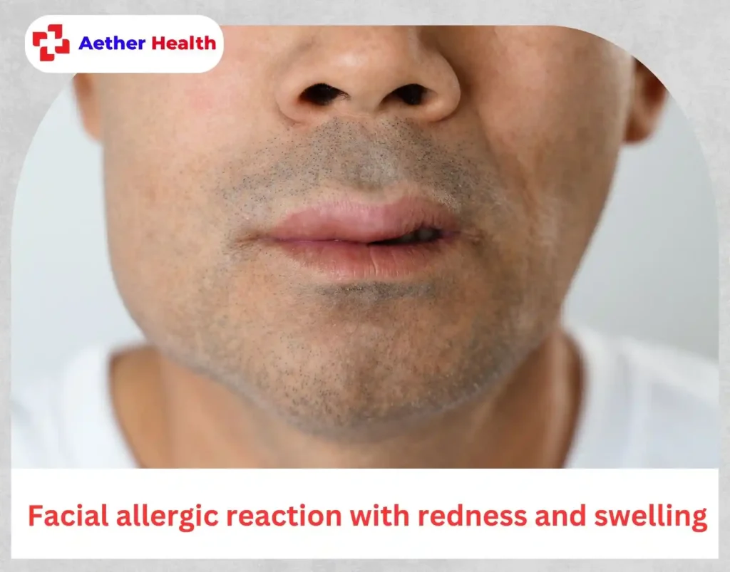 Facial allergic reaction with redness and swelling