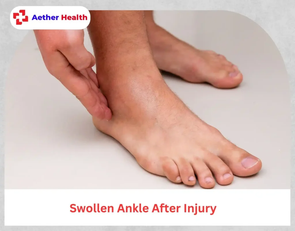 swollen sprained ankle with bruising